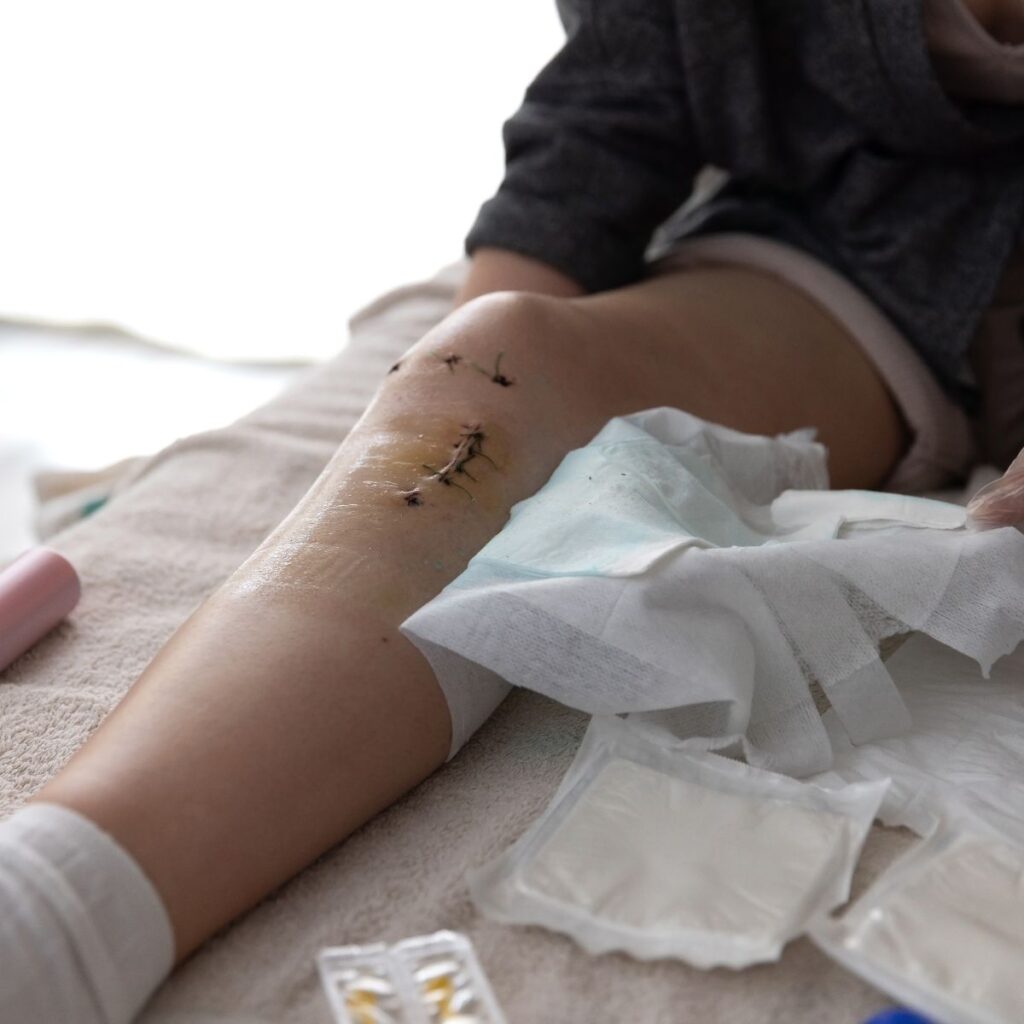 A stitched surgical scar on a person’s knee during recovery care